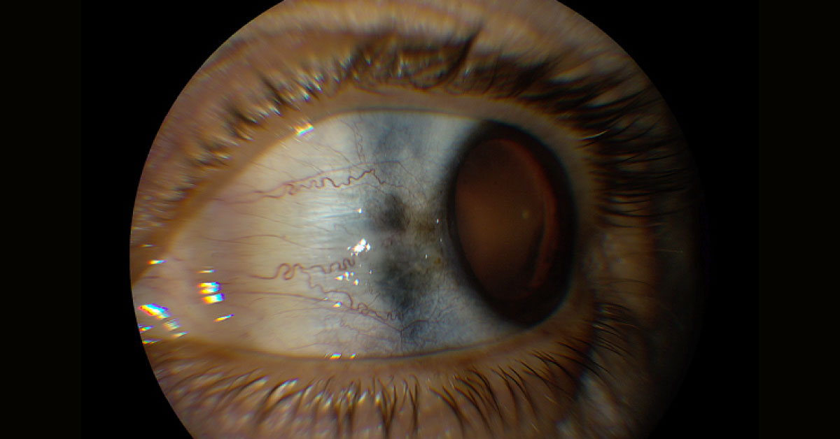 Resolve this Ophthalmologic case